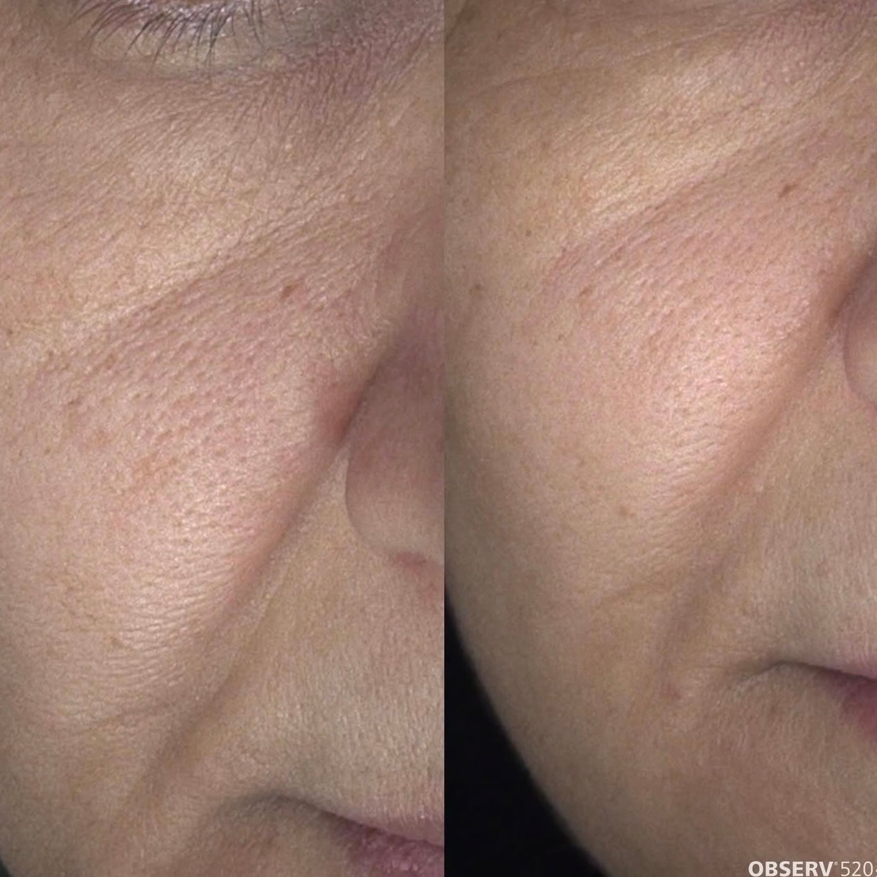 Dermapen4