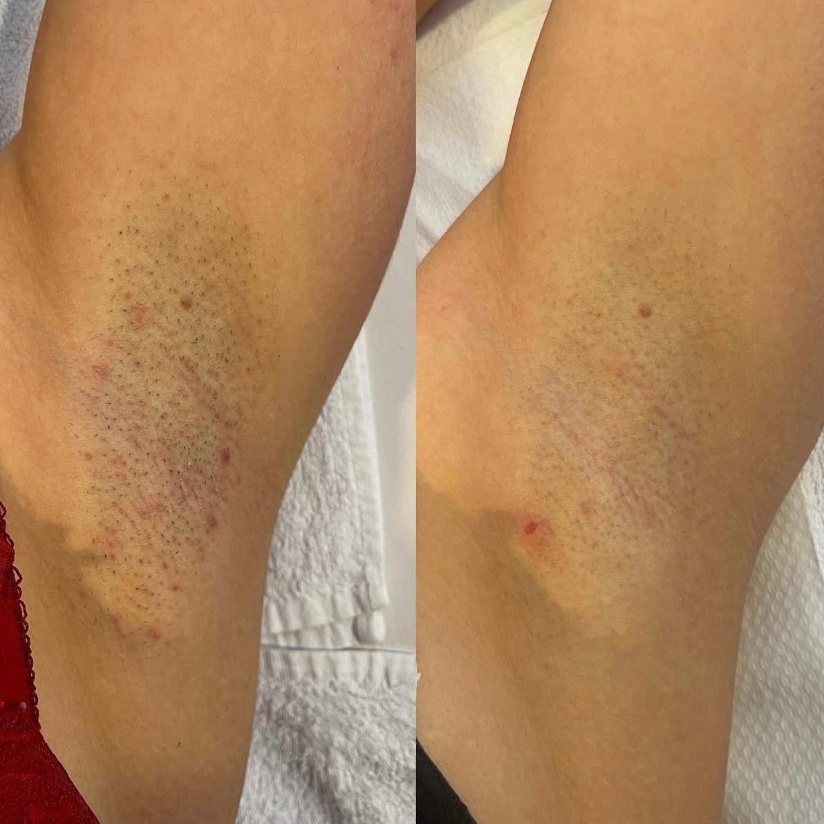 Laserontharing vrouwen