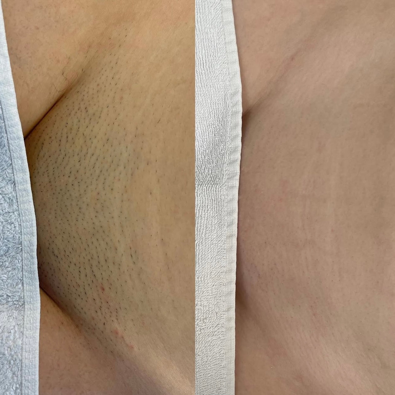 Laserontharing vrouwen